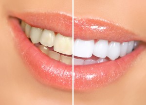 homemade teeth whitening